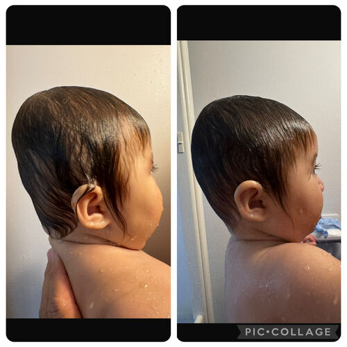 Antes e depois - vista de perfil